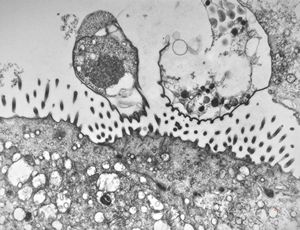 M,33y. | microsporidiosis (or cryptosporidiosis) - duodenum-posttransplantation immunodeficiency